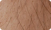 fazfae-dauerhafte-laser-haarentfernung-frauen-haartypen-und-hormone (4)