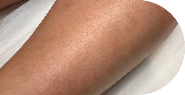 fazfae-dauerhafte-laser-haarentfernung-frauen-haartypen-und-hormone (5)
